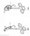 Fig. 02 - Thoracic access port including foldable anchor