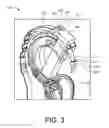 Fig. 03 - Insertion devices, anchors, and methods for securing an implant
