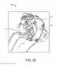 Fig. 14 - Insertion devices, anchors, and methods for securing an implant