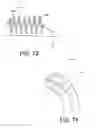 Fig. 35 - Insertion devices, anchors, and methods for securing an implant