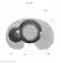 Fig. 50 - Systems and methods for preparing bone voids to receive a prosthesis