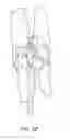 Fig. 16 - Bone anchor systems