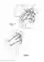 Fig. 02 - Method of dynamically compressing a fracture