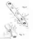 Fig. 07 - Method of dynamically compressing a fracture