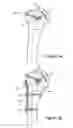 Fig. 06 - Articular fracture fixation system and method