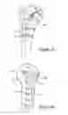 Fig. 07 - Articular fracture fixation system and method
