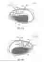 Fig. 05 - System and method for bronchial dilation
