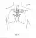 Fig. 07 - System and method for bronchial dilation
