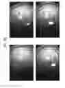 Fig. 28 - Prosthetic capsular devices, systems, and methods