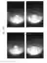Fig. 33 - Prosthetic capsular devices, systems, and methods