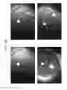 Fig. 35 - Prosthetic capsular devices, systems, and methods