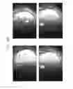 Fig. 41 - Prosthetic capsular devices, systems, and methods