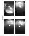Fig. 45 - Prosthetic capsular devices, systems, and methods
