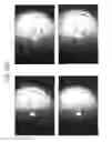 Fig. 46 - Prosthetic capsular devices, systems, and methods