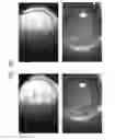 Fig. 53 - Prosthetic capsular devices, systems, and methods