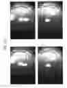 Fig. 63 - Prosthetic capsular devices, systems, and methods