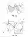 Fig. 02 - Truncated leaflet for prosthetic heart valves