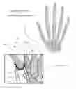 Fig. 01 - Surgical implantable stabilizer sling for basal joint arthroplasty