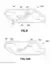 Fig. 09 - Plastically deformable inter-osseous device