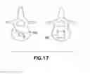 Fig. 17 - Plastically deformable inter-osseous device