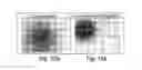 Fig. 07 - Composition comprising a TNFR agonist and at least one thioredoxin inhibitor for use in the treatment of carcinoma