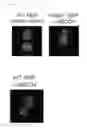 Fig. 35 - Methods of treating atherosclerosis or myeloproliferative neoplasms by administering a lyn kinase activator