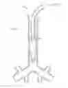 Fig. 02 - ENDOTRACHEAL CUFF AND TECHNIQUE FOR USING THE SAME