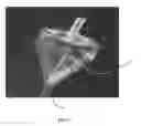 Fig. 05 - Ostomy pump system and related methods of use and manufacture