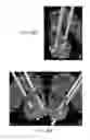 Fig. 26 - System and methods for multi-site activation of the thalamus