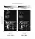 Fig. 40 - System and methods for multi-site activation of the thalamus