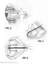 Fig. 06 - Golf club with polymeric insert and adjustable dynamic loft