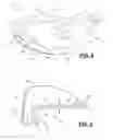 Fig. 05 - Golf club with removable weight