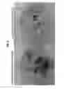 Fig. 07 - METHOD FOR GENERATING RETINAL PIGMENT EPITHELIUM (RPE) CELLS FROM INDUCED PLURIPOTENT STEM CELLS (IPSCs)