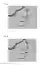 Fig. 10 - Method and system for prediction of post-stenting hemodynamic metrics for treatment planning of arterial stenosis