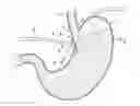 Fig. 01 - Method for treating gastroesophageal reflux disease