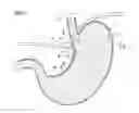 Fig. 02 - Method for treating gastroesophageal reflux disease