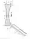Fig. 06 - Bone fixation with a pin and a collar