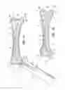 Fig. 08 - Bone fixation with a pin and a collar