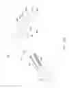 Fig. 20 - Method and apparatus for spondylolysis repair