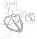 Fig. 08 - Electrosurgical device having a distal aperture