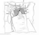 Fig. 01 - Cranial alignment device for use in intracranial stereotactic surgery