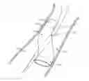 Fig. 01 - Methods and systems for providing or maintaining fluid flow through body passages