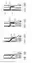 Fig. 22 - Methods and systems for providing or maintaining fluid flow through body passages