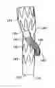 Fig. 01 - Branched vessel endoluminal device