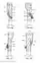 Fig. 08 - Branched vessel endoluminal device