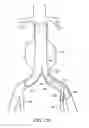 Fig. 16 - Branched vessel endoluminal device