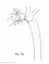 Fig. 32 - Branched vessel endoluminal device