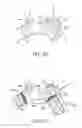 Fig. 33 - Branched vessel endoluminal device