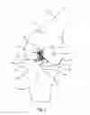 Fig. 02 - Double bundle ACL repair
