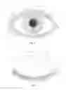 Fig. 03 - Ciliary implant, ciliary augmentation